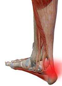 heel_pain_-tendonitis_natural_relief